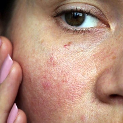 بهترین راهکارهای درمان عروق عنکبوتی