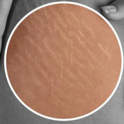 با این روش‌ با استرچ مارک خداحافظی کن!