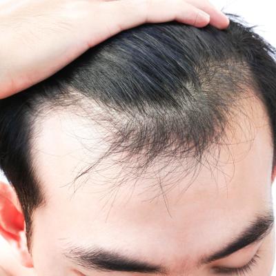 درمان جدید ریزش مو ناشی از استرس