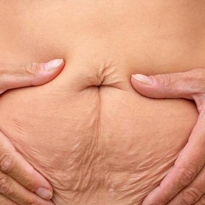 درمان شل شدن پوست بعد از لاغری؛ جدیدترین روش‌های 2026